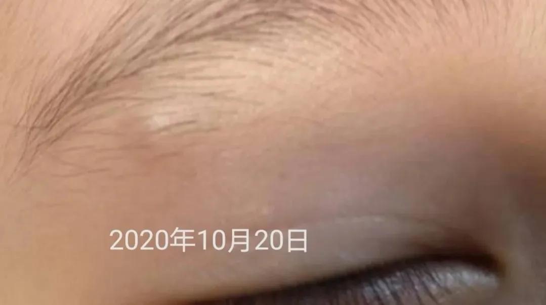 皮脂腺囊肿挤出囊袋,皮脂腺囊肿切除手术