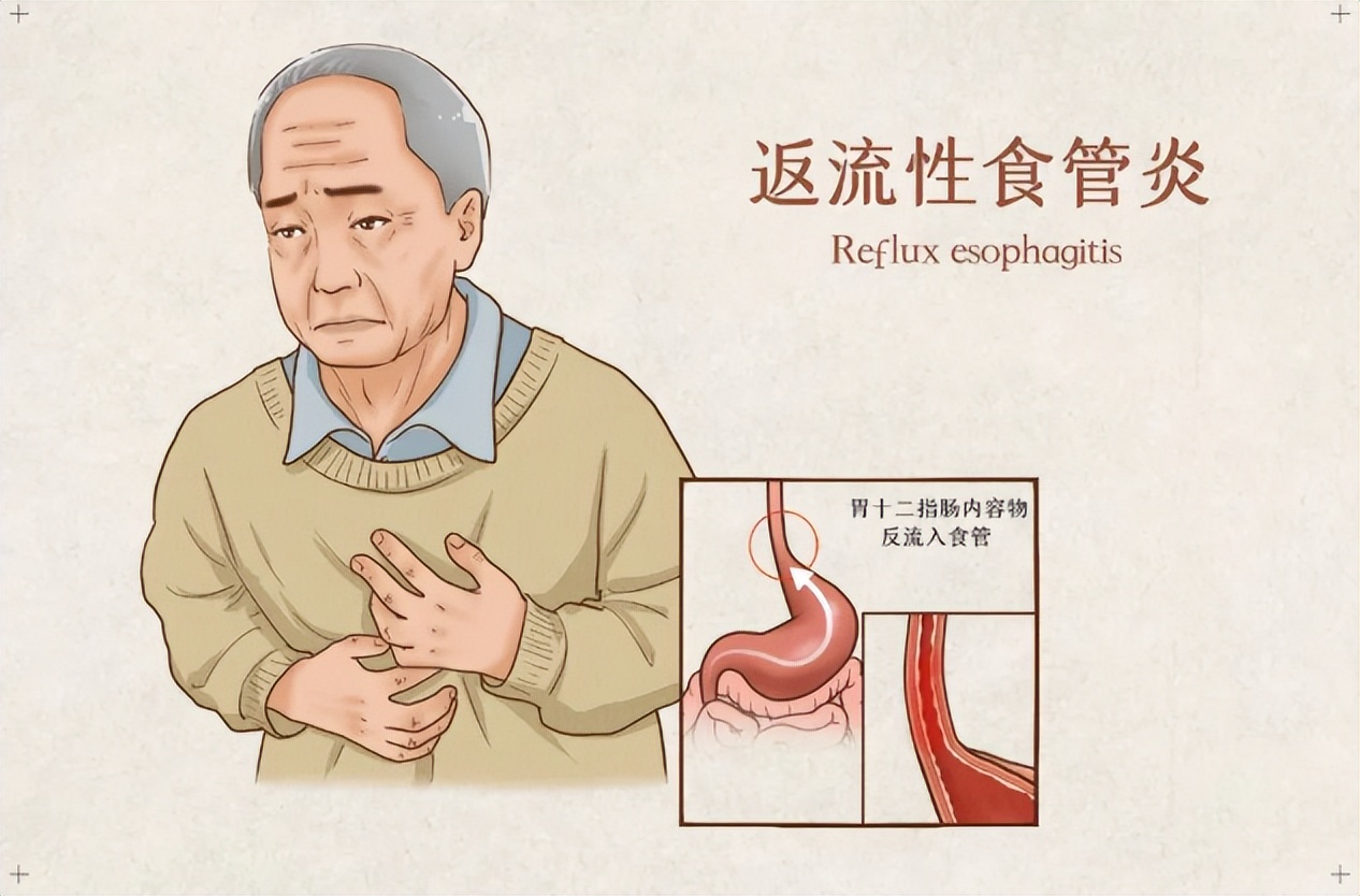 张仲景治疗反流性食管炎中药方,张仲景治反流性食管炎最好的方子