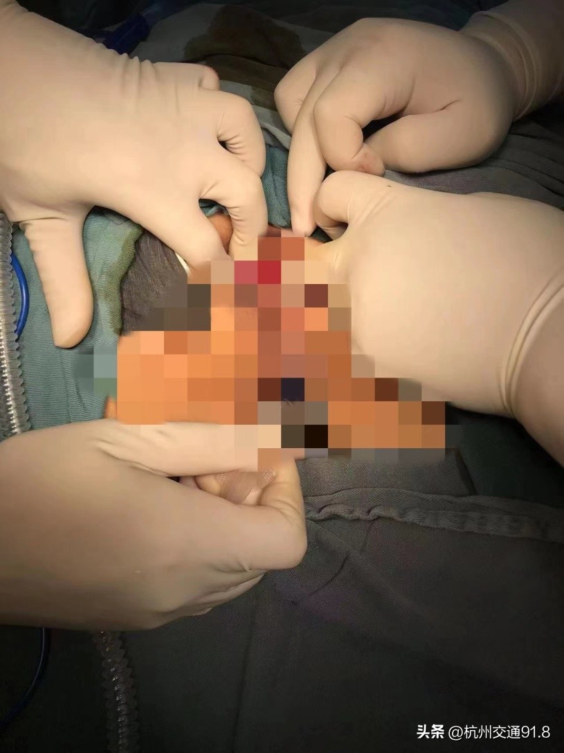 因为一个痘痘做了手术,因为一个痘痘做了个手术