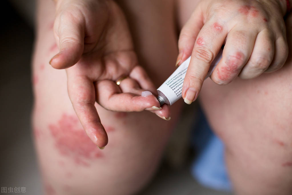 银屑病传染吗听听专家是怎么说的,得过银屑病的人可以传染吗