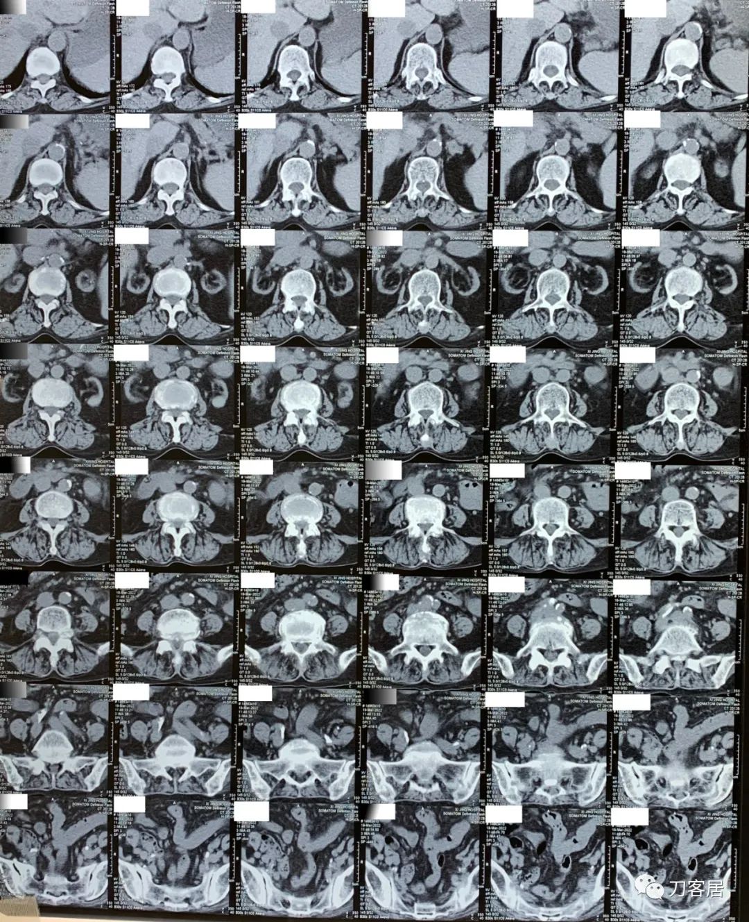 75岁老人腰间盘突出可以做手术吗,70岁老人腰间盘突出做手术