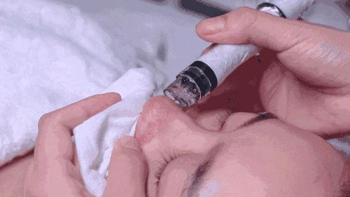 额头眉心发红有闭口粉刺,眉心鼻头频繁起粉刺怎么办