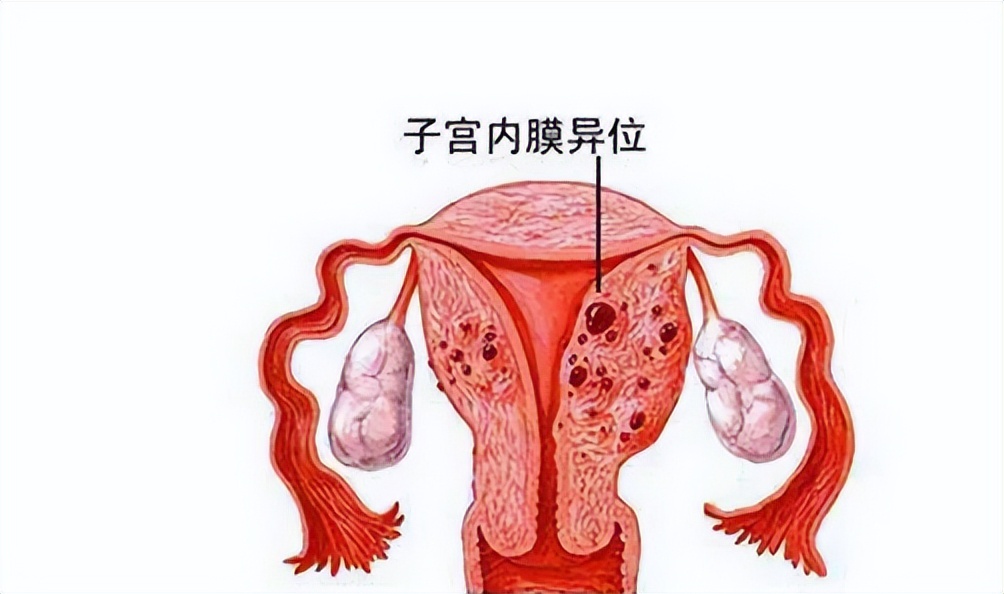 为什么会有子宫内膜异位症,为什么会得子宫内膜异位症