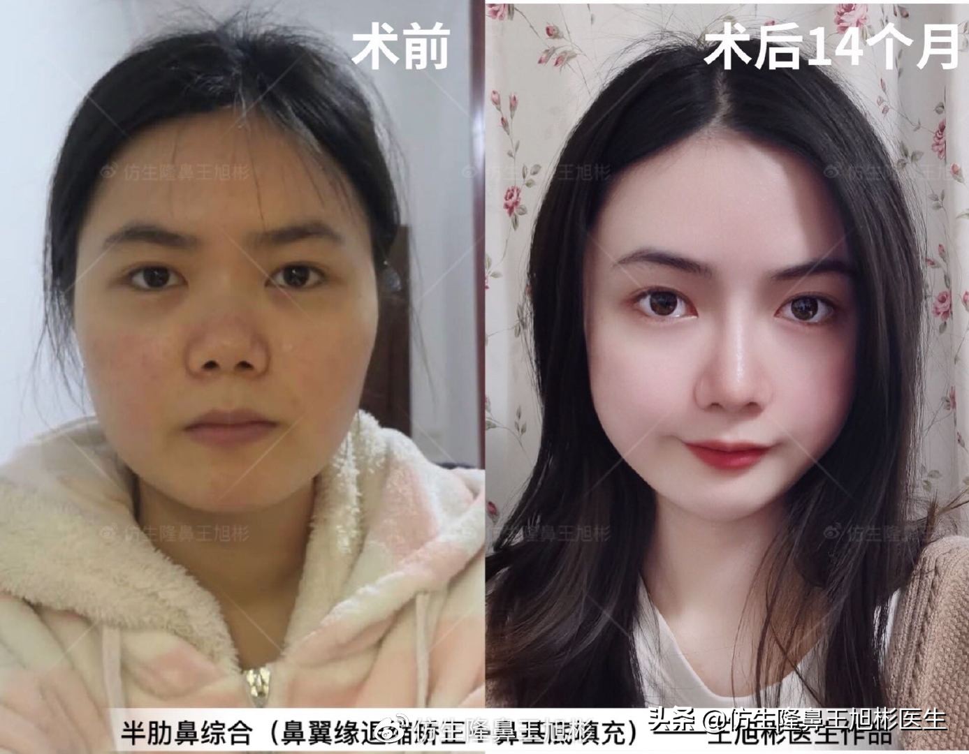 常见鼻部整形美容项目,整形鼻和自然鼻