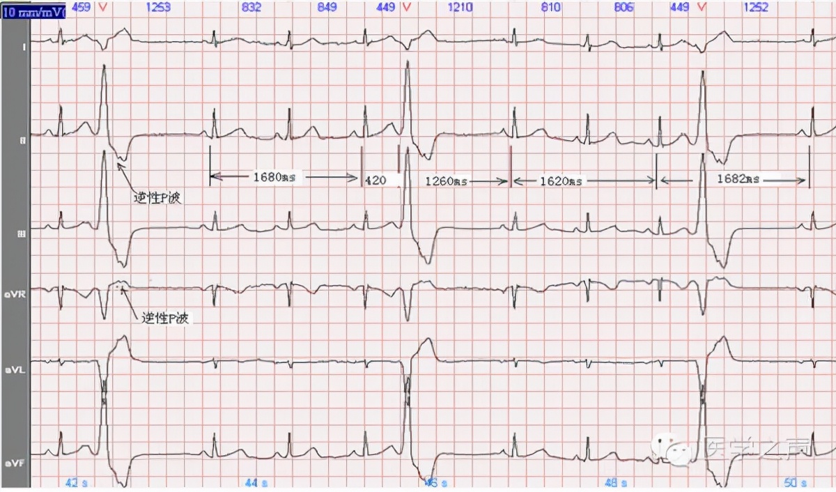 早搏需要治吗4大误区要知道,早搏必须要治疗吗