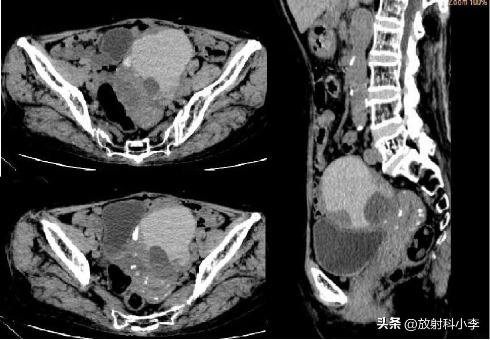 妇科急腹症的ct表现,妇科急腹症的诊断与治疗
