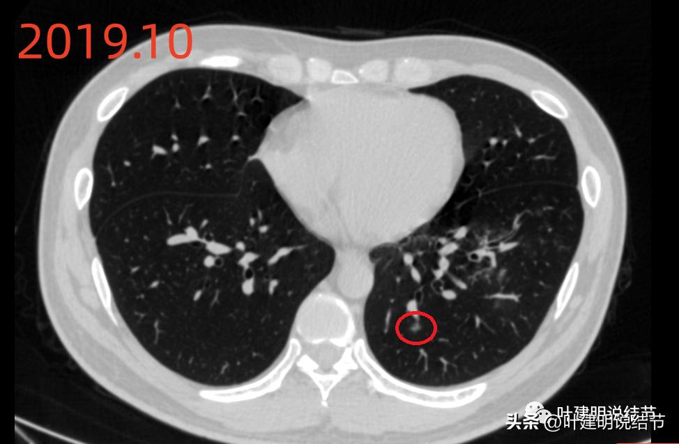 肺炎好了磨玻璃结节还存在,球形肺炎治愈后肺部留有结节