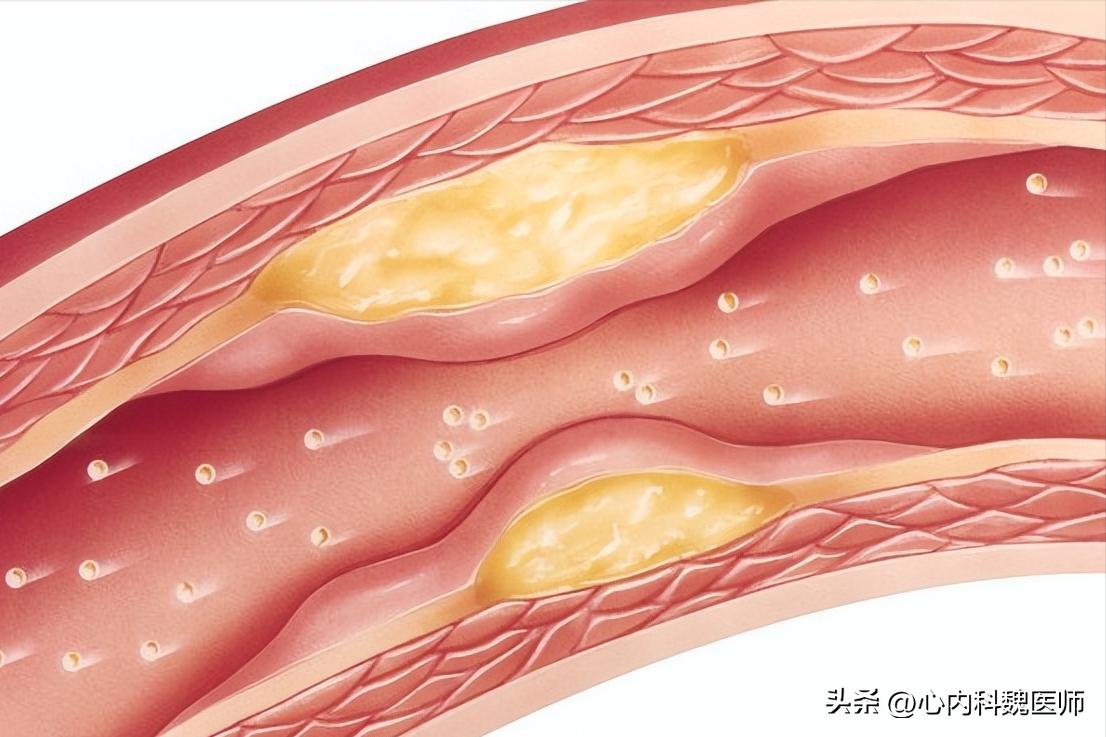 低密度脂蛋白高怎么才能降下来,低密度脂蛋白高怎样降下来