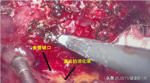 喝酒喝多了胃穿孔怎么治疗,喝酒食道管破裂还有救吗