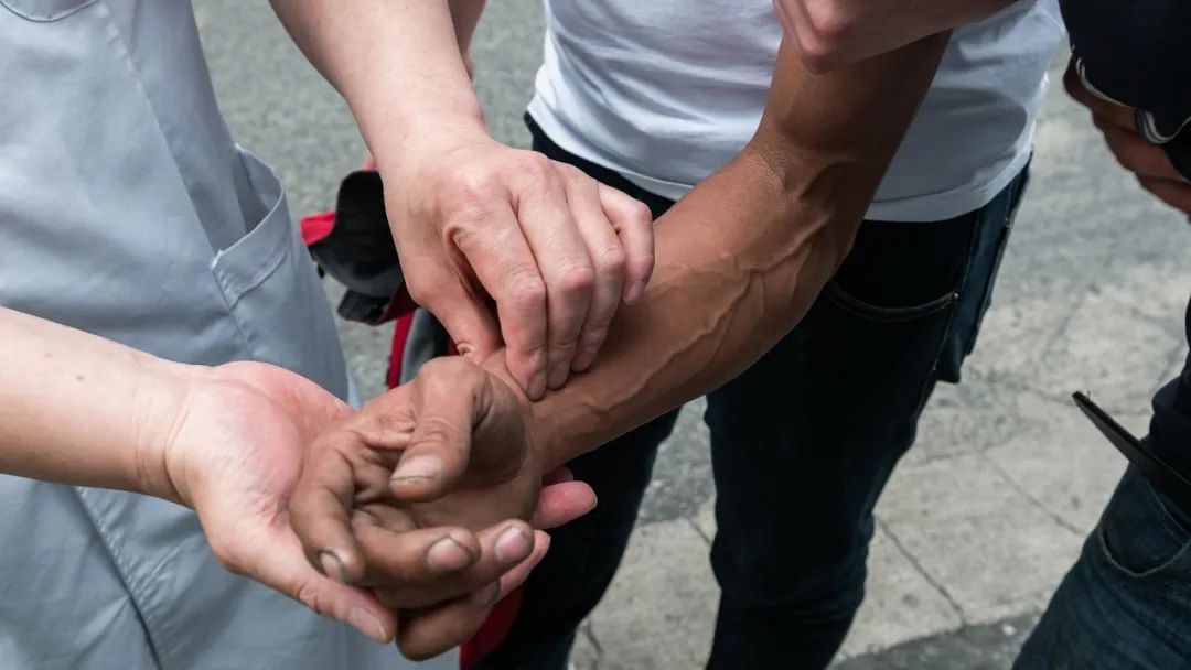 青春期甲亢早期症状有哪些,如果得了甲亢早期有什么症状