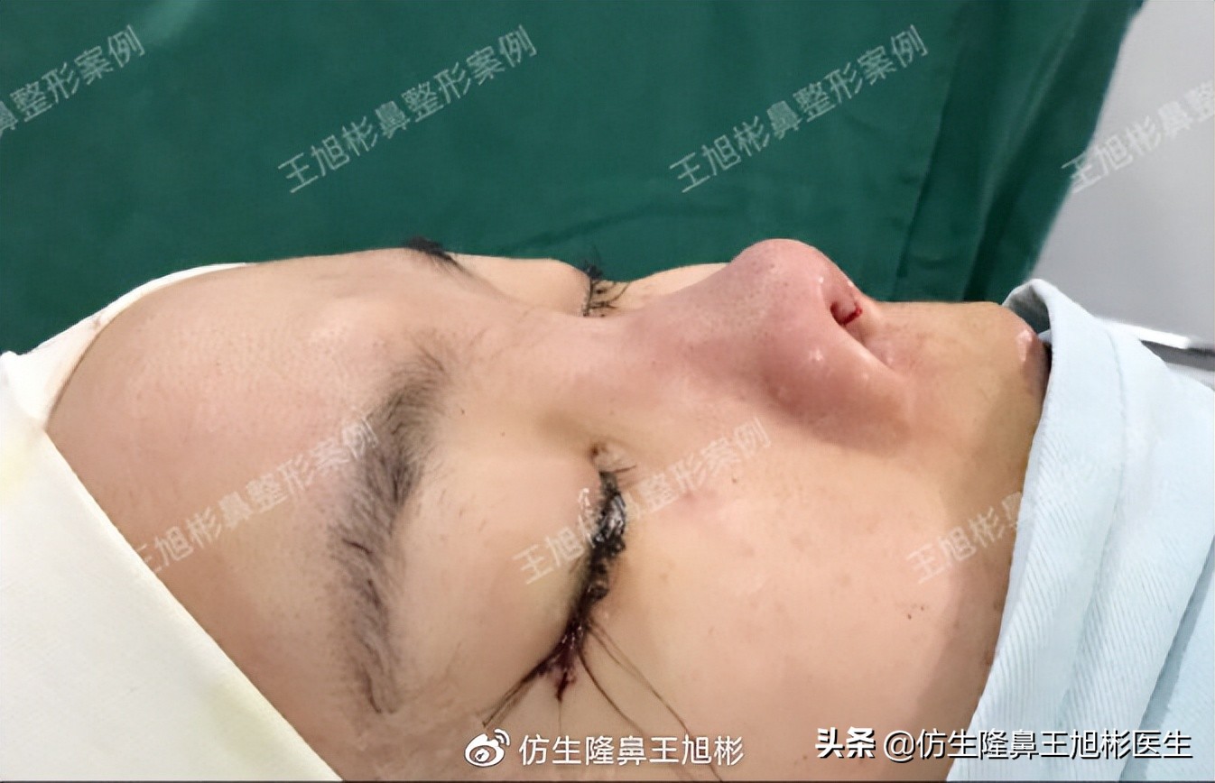 短鼻蒜头鼻整形,短鼻延长术切口