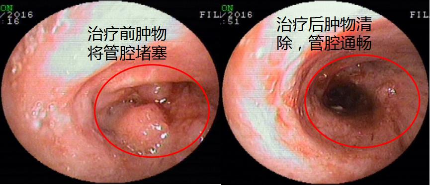 气管镜下肿瘤怎么治疗,气管肿物是什么
