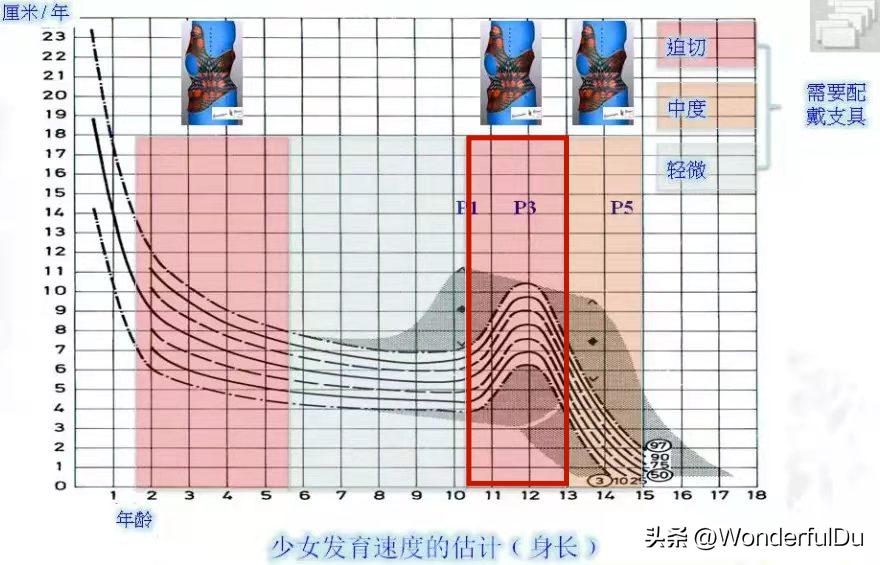 脊柱侧弯矫正改善,脊柱侧弯达到多少度需要矫正