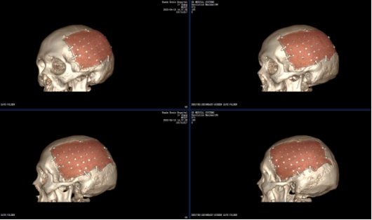 合肥华安脑科医院修复巨型颅骨缺损丨华安精湛医术，重塑颅骨