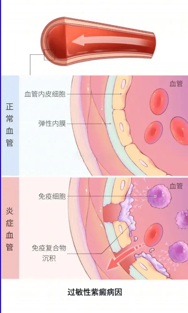 过敏性紫癜出血点越来越多,过敏性紫癜出血点的特征是怎样的