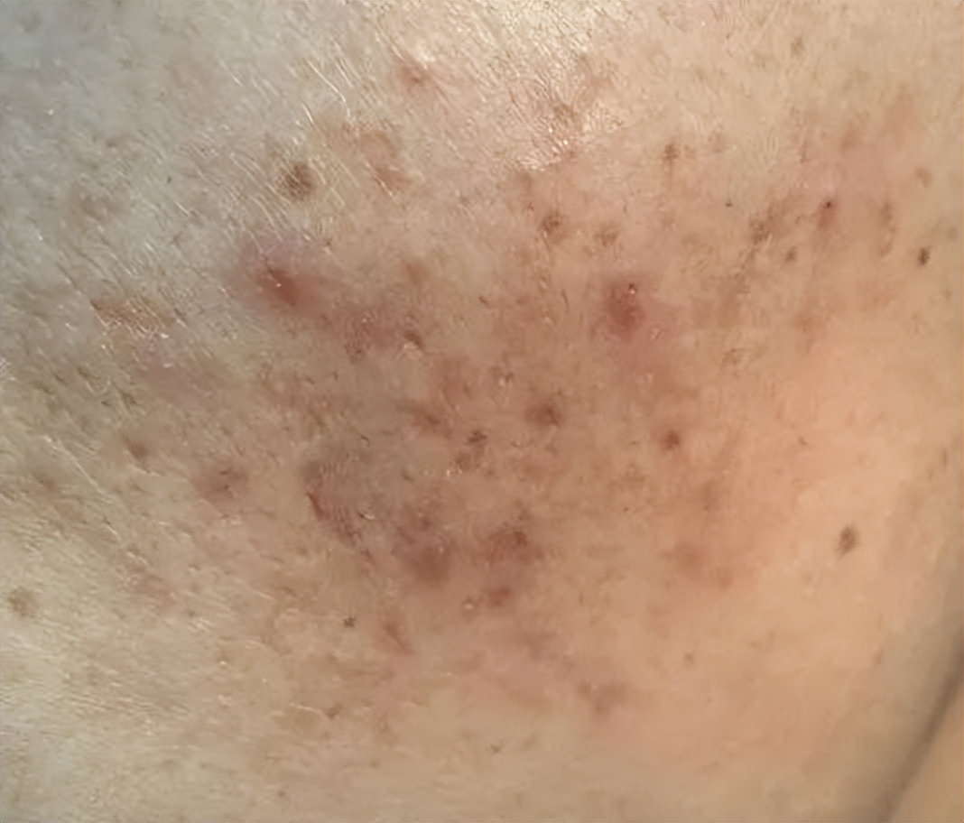 治疗痘印最有效的医美手段,脸部痘印中医能治疗嘛