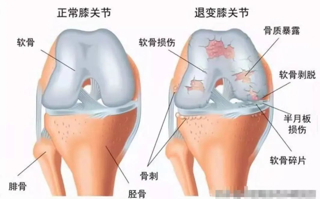 软骨保护类药有哪些,软骨保护关节吗