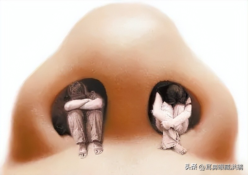 鼻中隔偏曲加上颌窦炎,鼻中隔偏曲和鼻甲手术区别