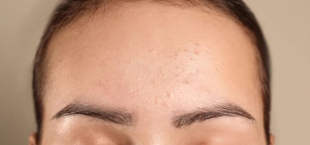 鼻子周围起疙瘩怎么回事,鼻子周围红肿起疙瘩吃什么药