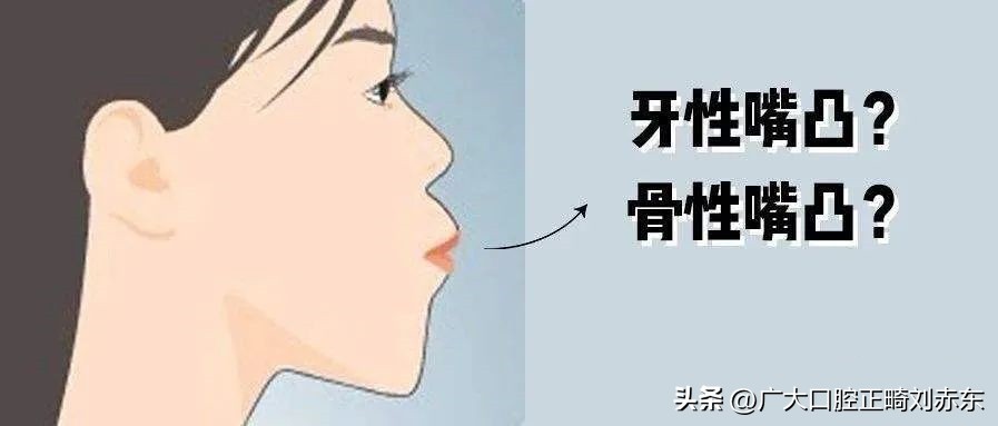 嘴凸要做正畸还是正颌,嘴凸下巴后缩应该正畸还是正颌