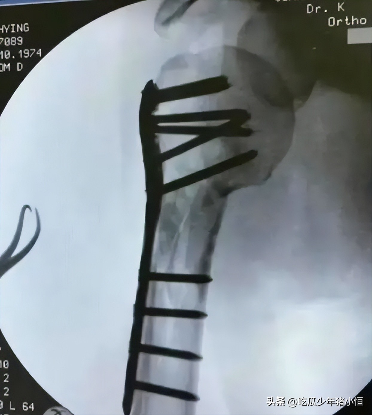 林志颖参加活动拄拐吗,44岁林志颖出席活动如小鲜肉