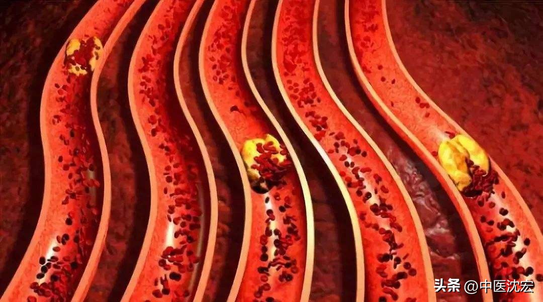 瘀血有什么药可以治疗吗,瘀血用什么药膏快速消除