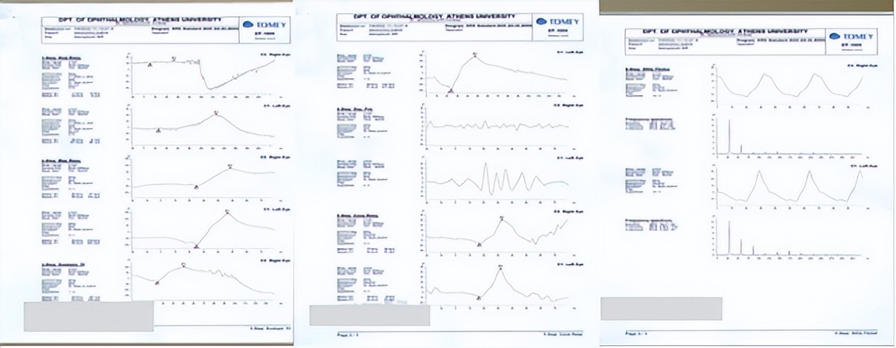 视网膜炎oct的详细图解,视网膜色素变性oct检查
