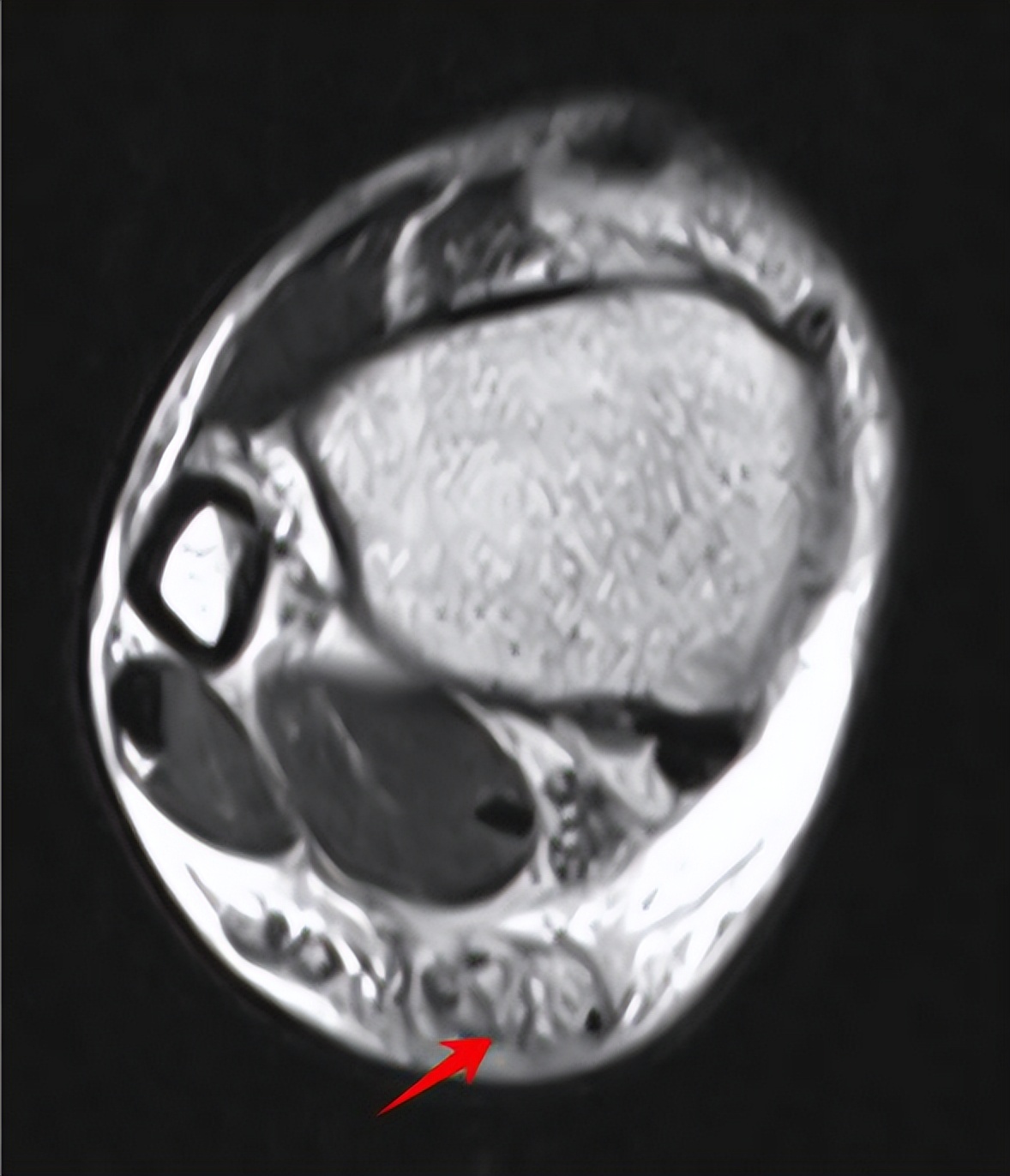 跟腱断裂对运动员的影响,运动员跟腱疼痛怎么解决