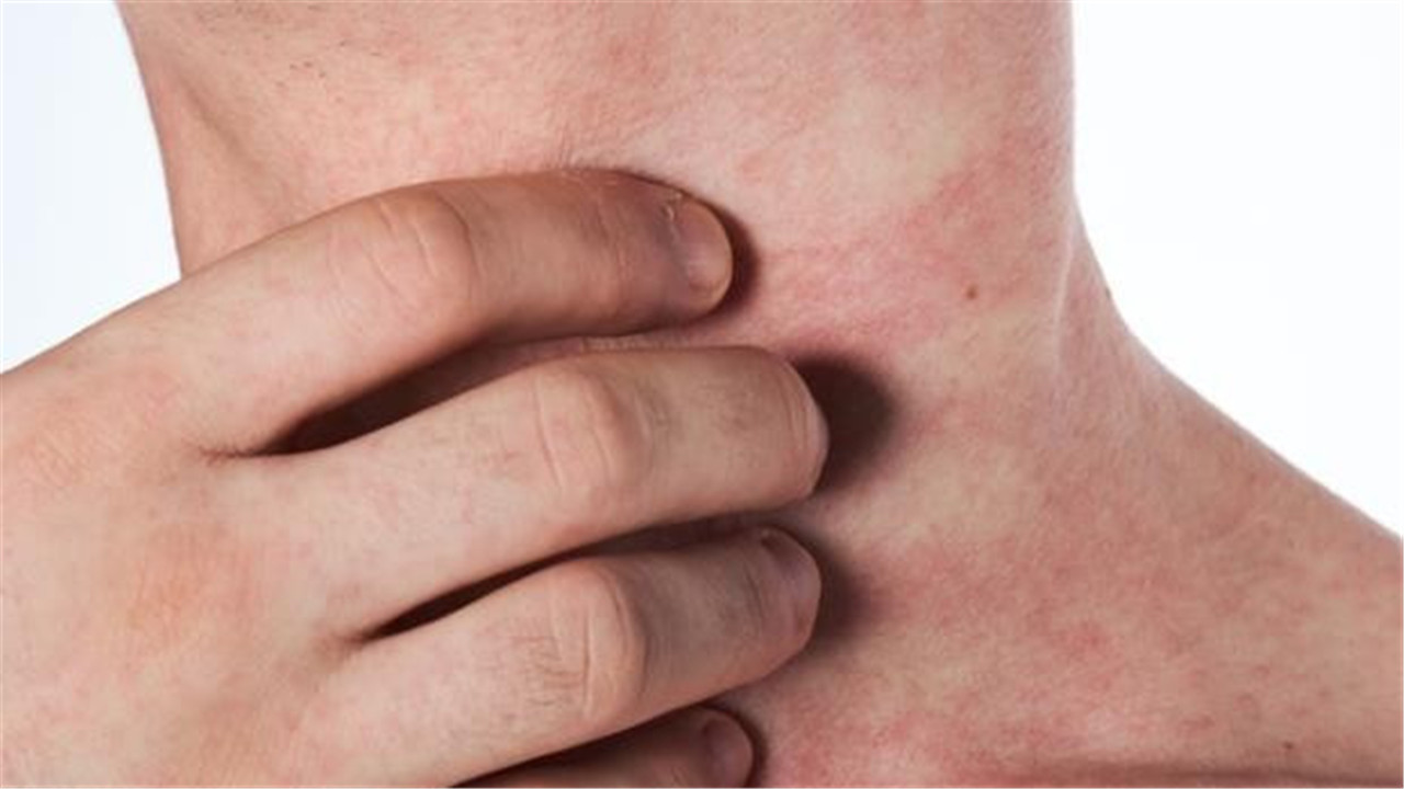 错把艾滋病当皮肤病怎么办,别把艾滋病当皮肤病