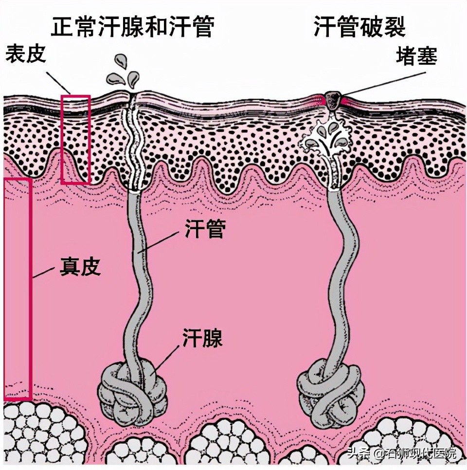 肛周化脓性汗腺炎怎样治才能好,屁股上经常起肛周脓肿怎么回事