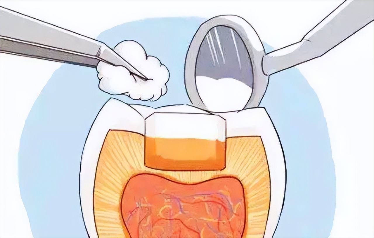 牙齿掉了一小块怎么办,拔牙掉了一块肉怎么办