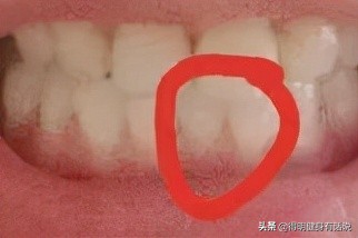 牙齿快暴露牙本质了怎么修复,牙齿已经露出牙本质了怎么修复