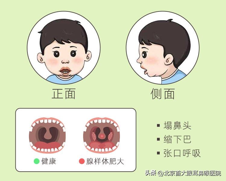 闭嘴呼吸能改善腺样体面容吗,已经成年了腺样体面容怎么改善