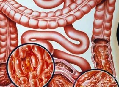 治结肠炎直肠炎的药,直肠炎结肠炎肛管炎