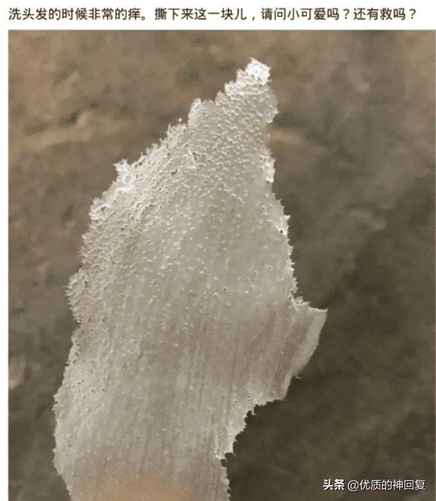头发洗了一天就很油很痒怎么回事,头发天天洗还是痒得厉害怎么回事