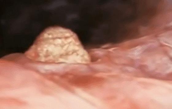 胚胎移植后1到10天的着床注意事项,胚胎移植后14到30天发育情况