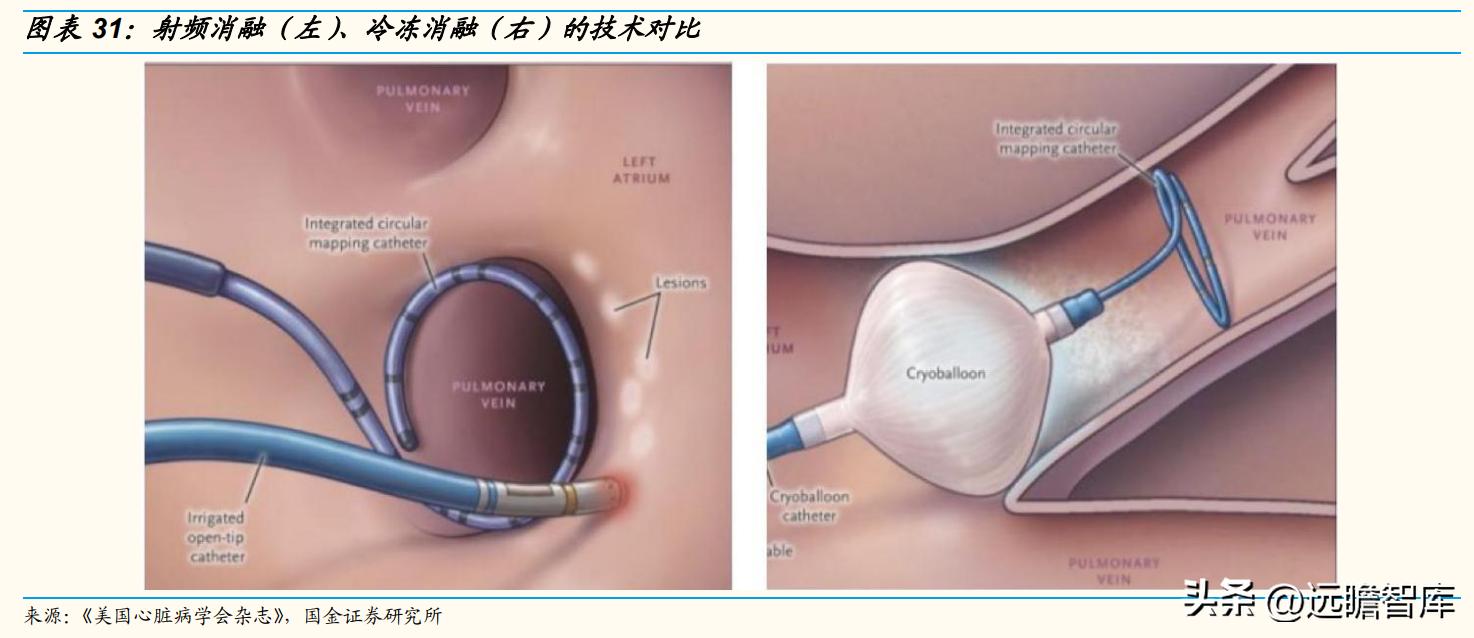 专注电生理介入诊疗，微电生理：市场高速成长，国产替代空间巨大