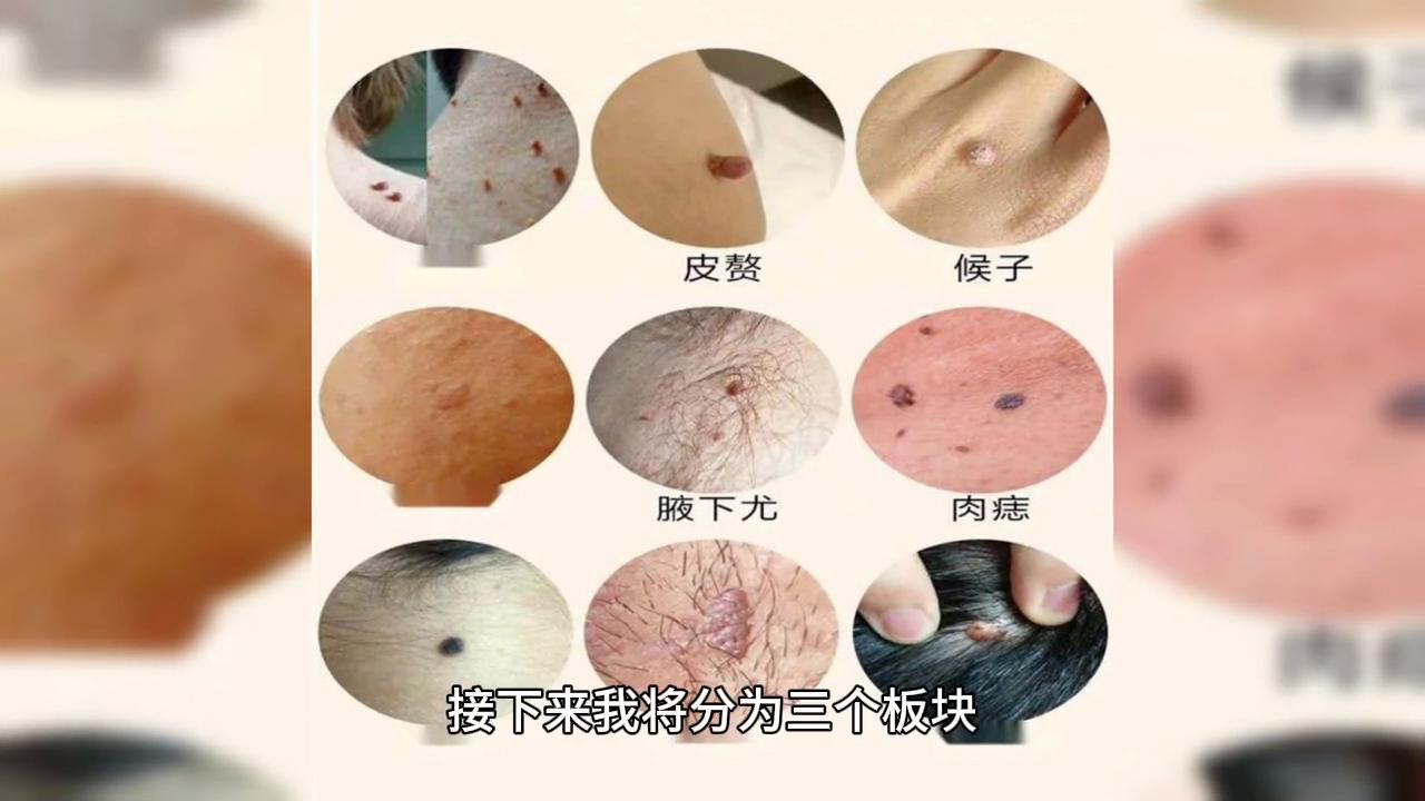 希君美祛痣几天脱落,希君美去痣有用吗