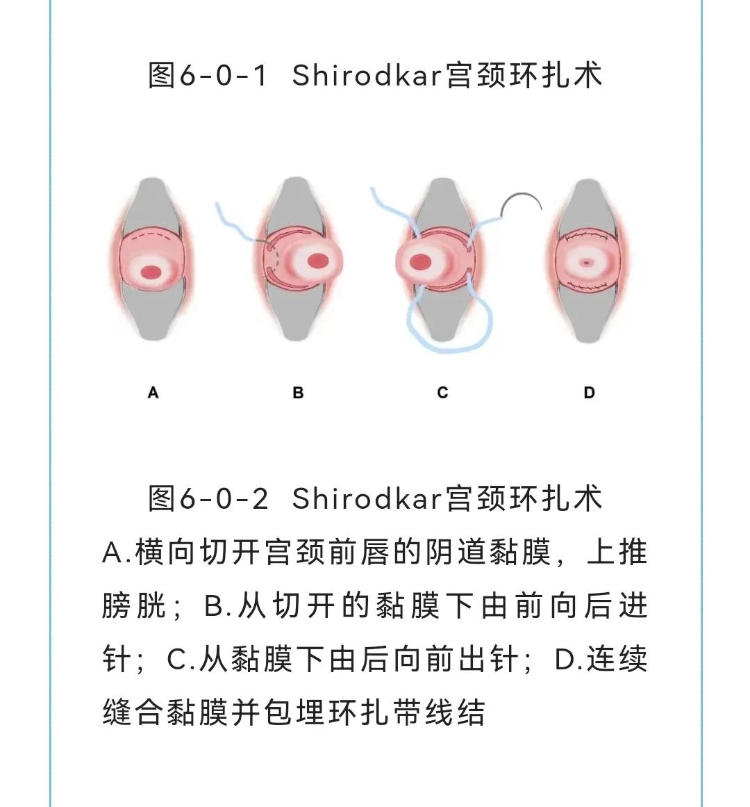 双胞胎怀孕20周，医生竟然要缝合我的宫颈