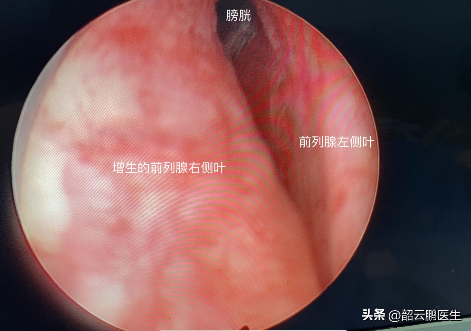 前列腺增生服用坦索罗辛效果不好,前列腺增生吃坦索罗辛能治好吗