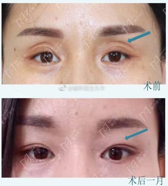 做双眼皮手术后眼角凹陷,做双眼皮后眼角凹陷怎么回事