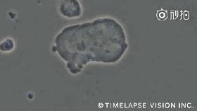 肝癌nk细胞免疫治疗,nk细胞治疗肿瘤最好的专家