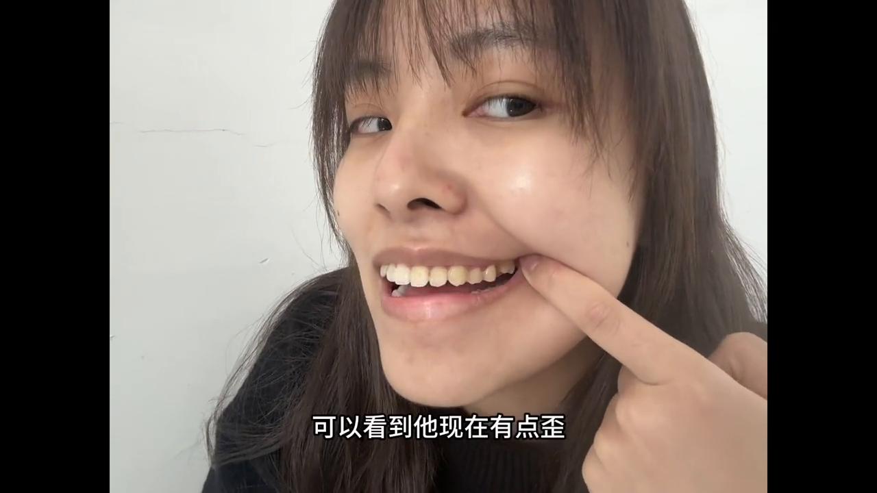 时隔两月终于给大家出这个牙齿视频了，好多人私信问我局部矫正