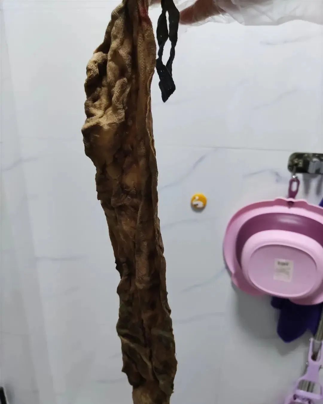 纱布留产妇体内后续,医生把纱布遗留产妇腹中紧急手术