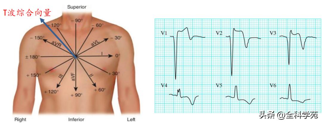 t波倒置三种常见原因,t波低平倒置有事吗