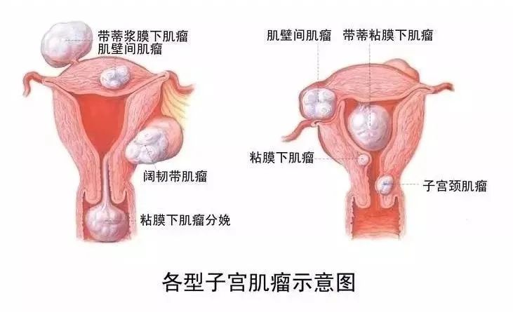 妇科肿瘤年轻化应该怎么预防,妇科恶性肿瘤有哪些早期信号