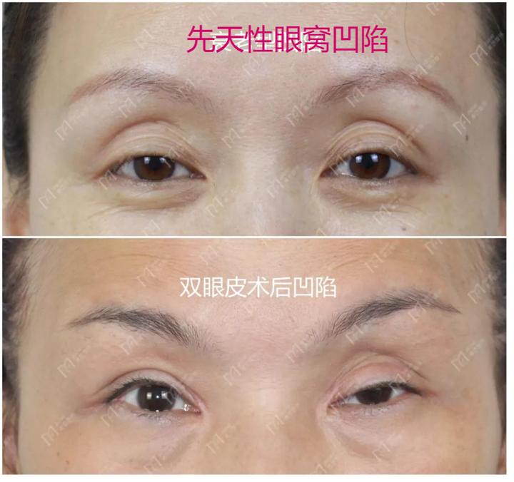 做双眼皮手术后眼角凹陷,做双眼皮后眼角凹陷怎么回事