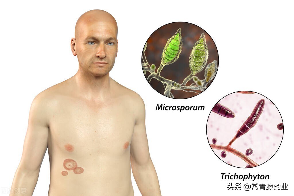 下体生癣要擦什么药膏好,霉菌一定要彻底清除吗