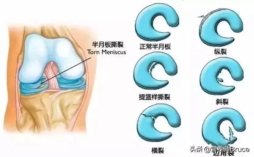 半月板作用及功效,热敷对半月板损伤有治疗作用吗