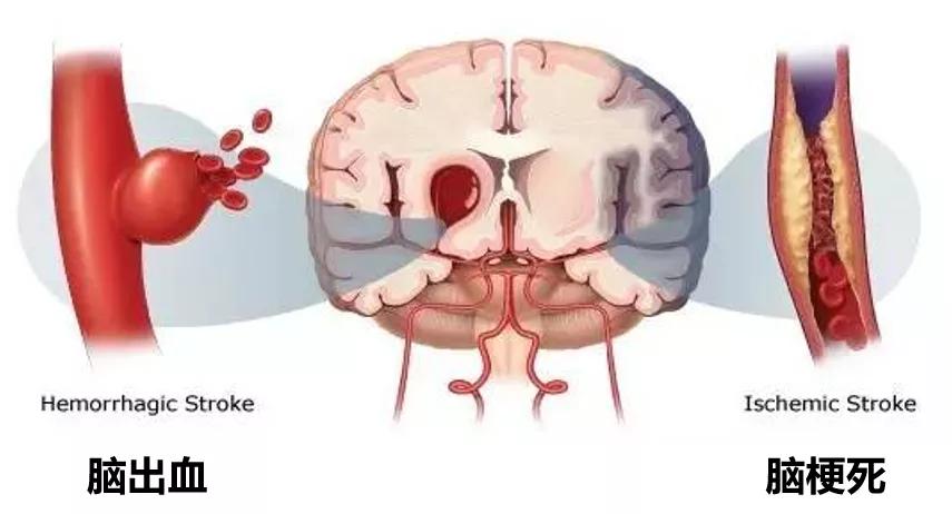 高血压和血型有关系没,高血压高血糖难兄难弟